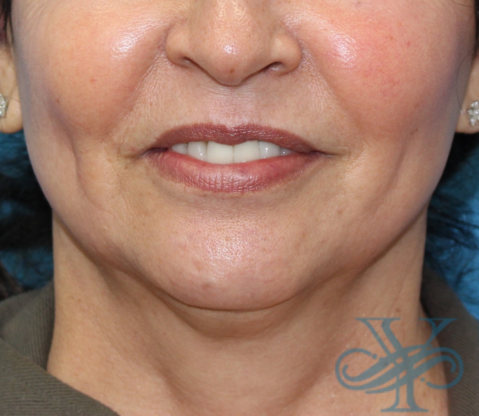 Before Kybella Dr. Yegiyants, Santa Barbara, CA