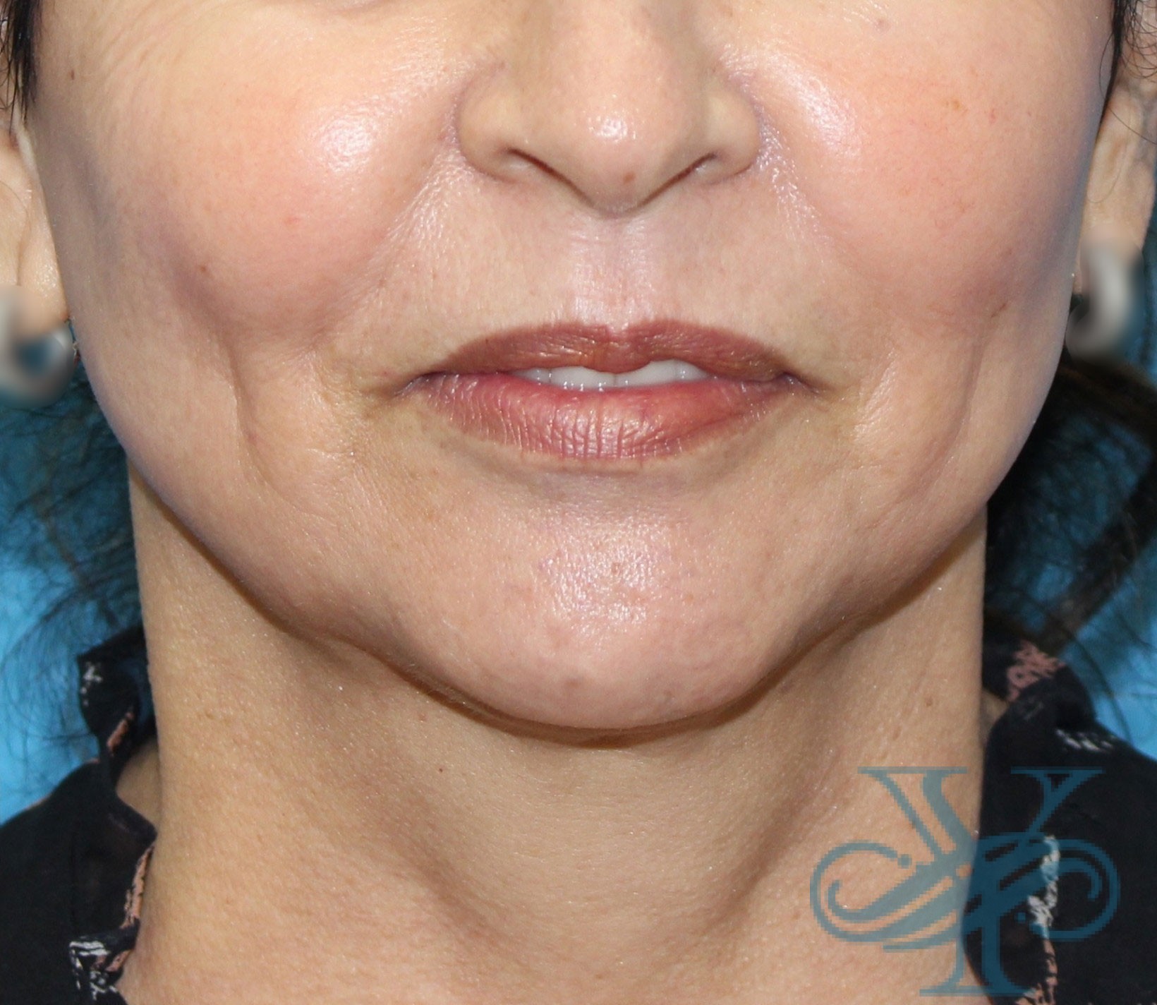 After Kybella Dr. Yegiyants, Santa Barbara, CA