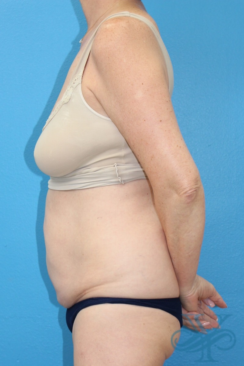 Before coolsculpting Dr. Yegiyants, Santa Barbara, CA