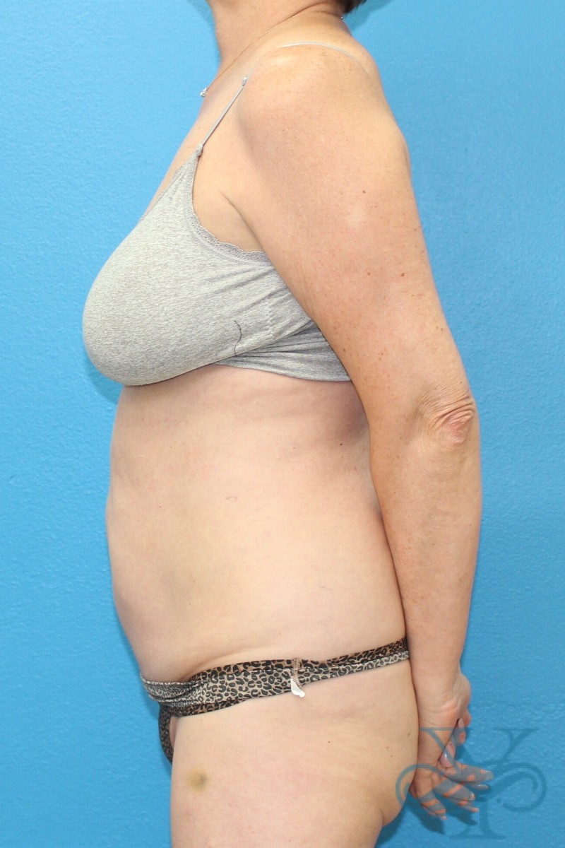 After coolsculpting Dr. Yegiyants, Santa Barbara, CA