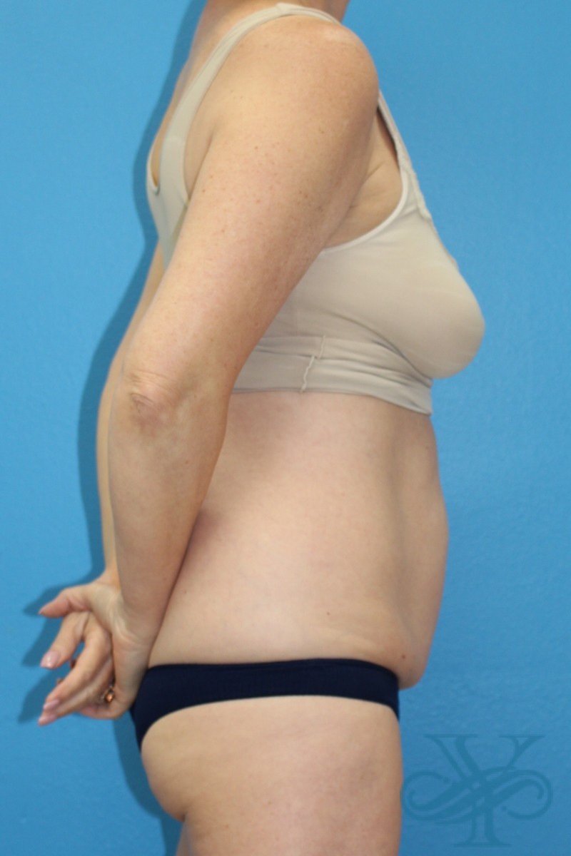 Before coolsculpting Dr. Yegiyants, Santa Barbara, CA
