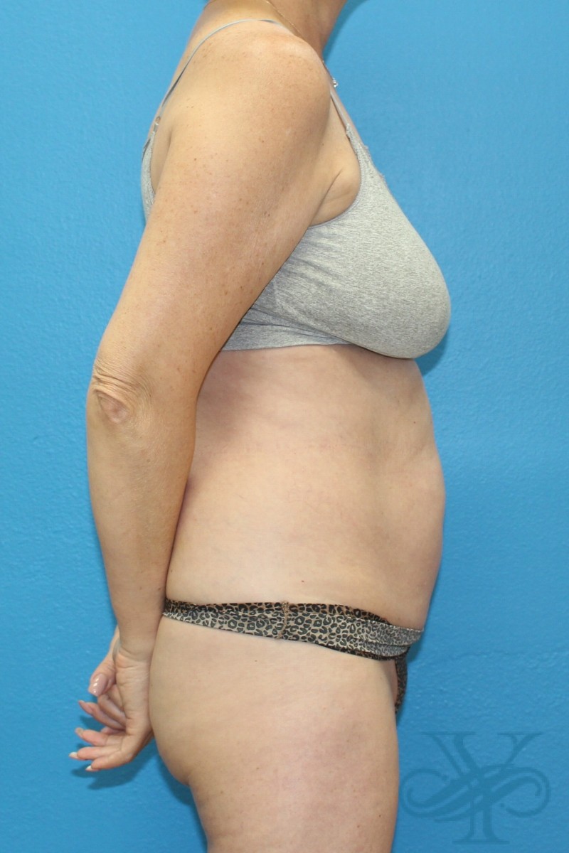 After coolsculpting Dr. Yegiyants, Santa Barbara, CA