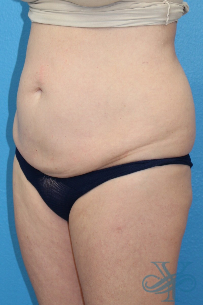 Before coolsculpting Dr. Yegiyants, Santa Barbara, CA