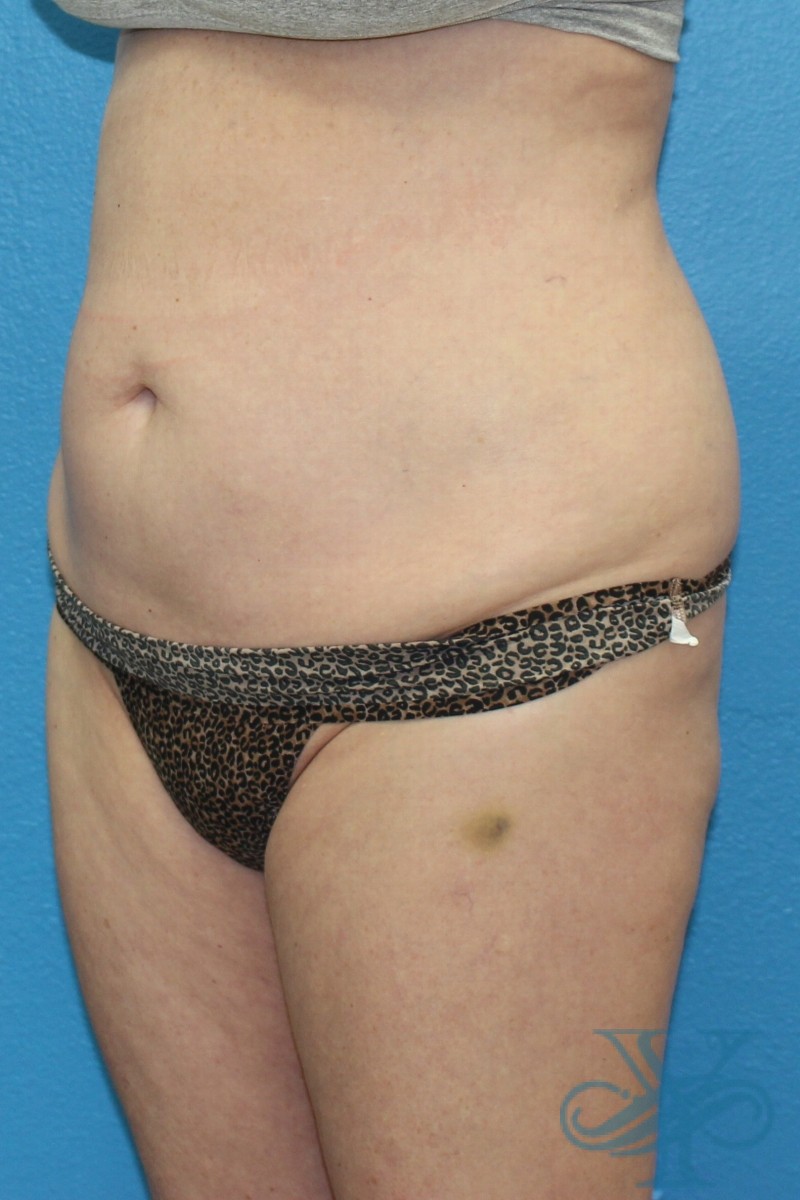 After coolsculpting Dr. Yegiyants, Santa Barbara, CA
