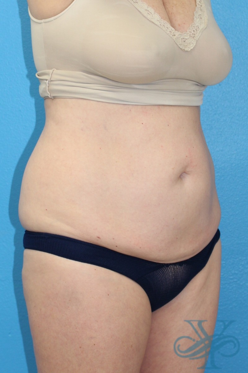 Before coolsculpting Dr. Yegiyants, Santa Barbara, CA