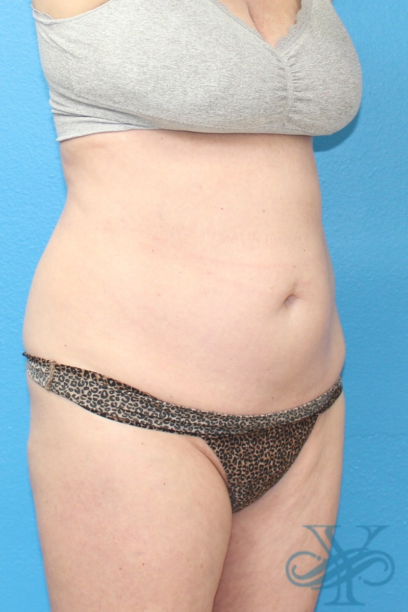 After coolsculpting Dr. Yegiyants, Santa Barbara, CA