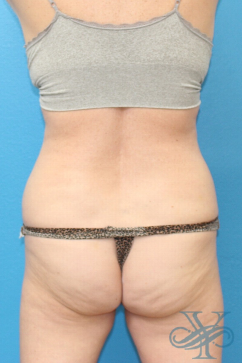 After coolsculpting Dr. Yegiyants, Santa Barbara, CA