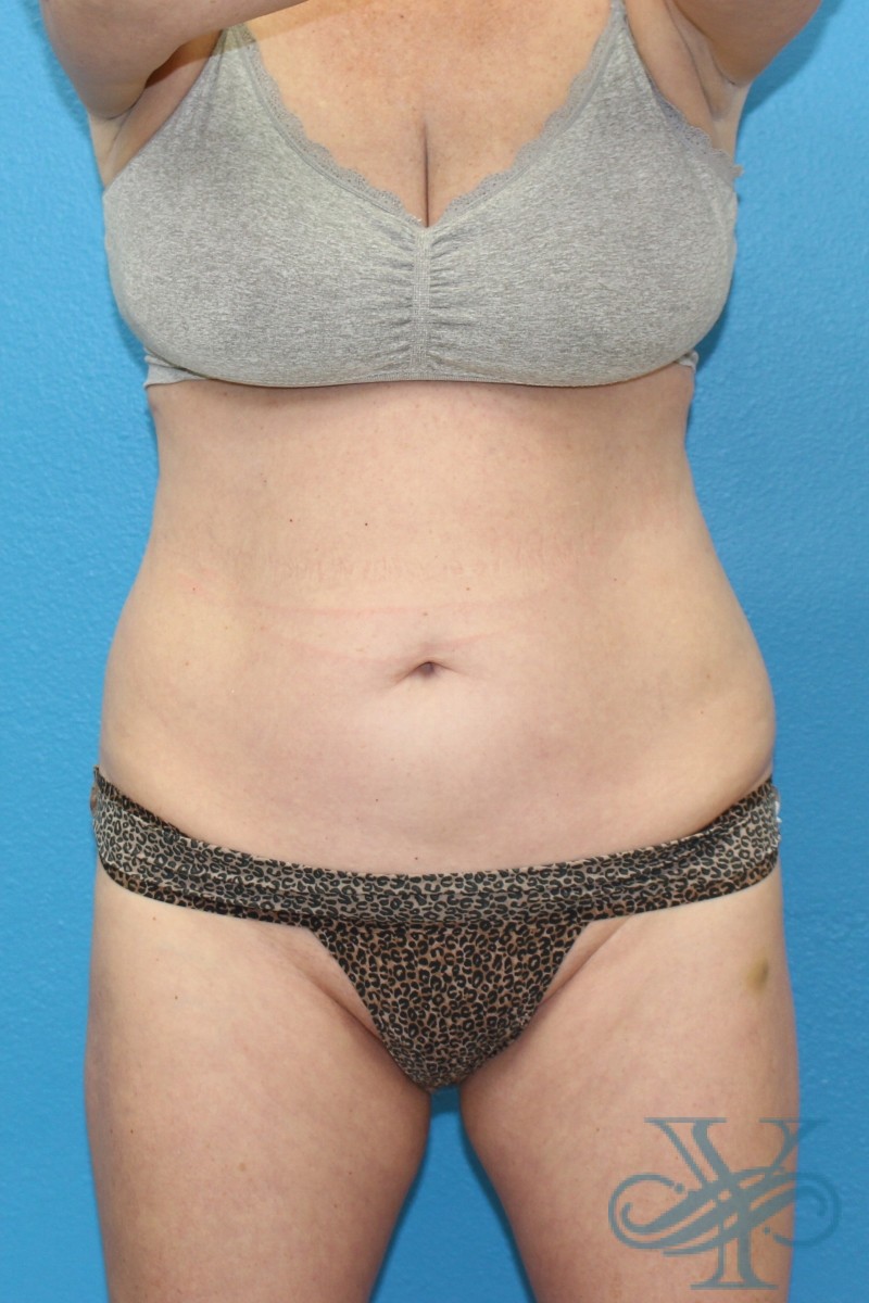 After coolsculpting Dr. Yegiyants, Santa Barbara, CA