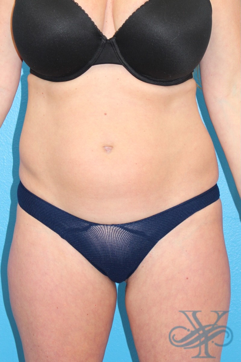 Before coolsculpting Dr. Yegiyant, Santa Barbara, CA