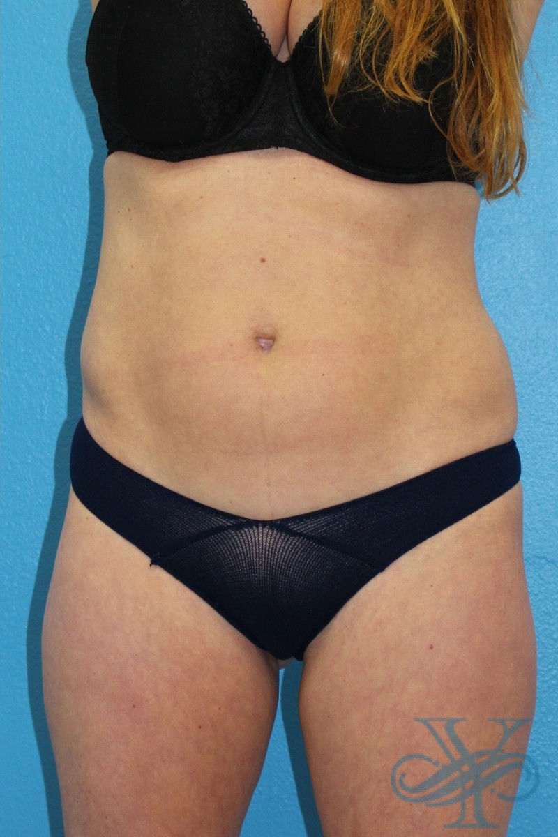 After coolsculpting Dr. Yegiyant, Santa Barbara, CA