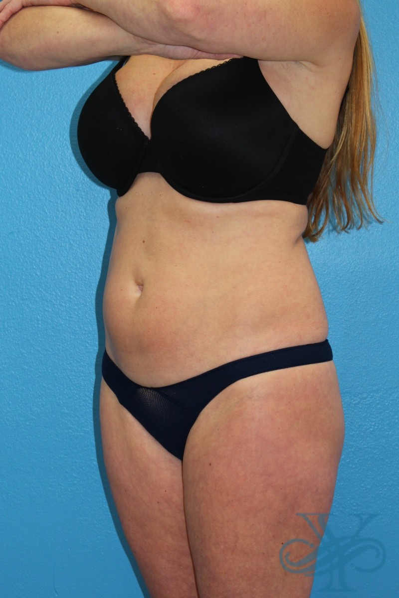 Before coolsculpting Dr. Yegiyant, Santa Barbara, CA