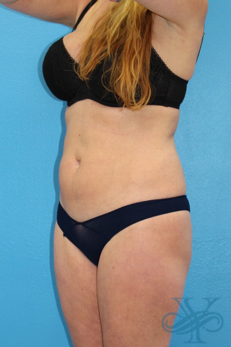 After coolsculpting Dr. Yegiyant, Santa Barbara, CA