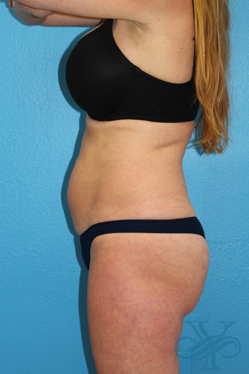 Before coolsculpting Dr. Yegiyant, Santa Barbara, CA