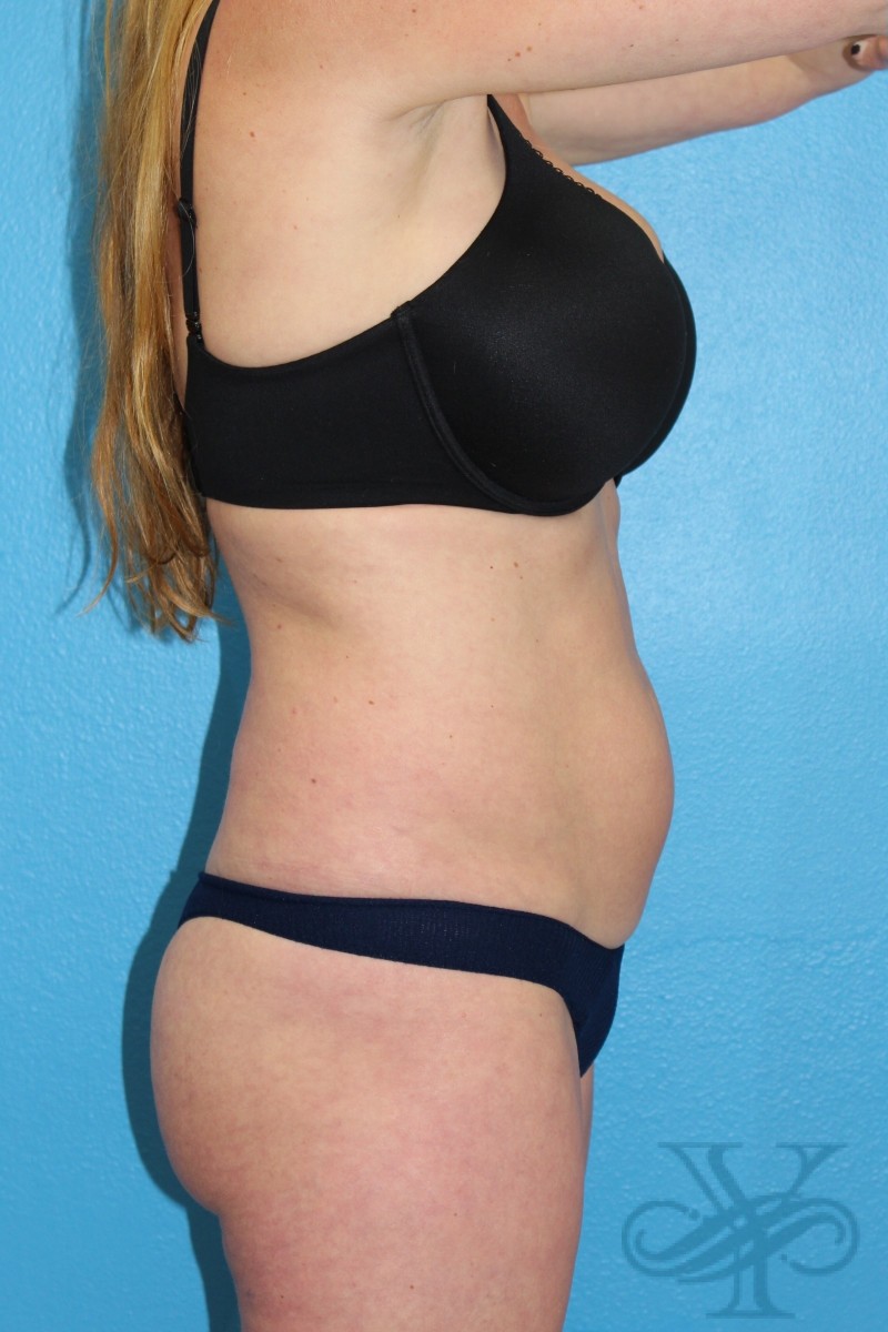 Before coolsculpting Dr. Yegiyant, Santa Barbara, CA