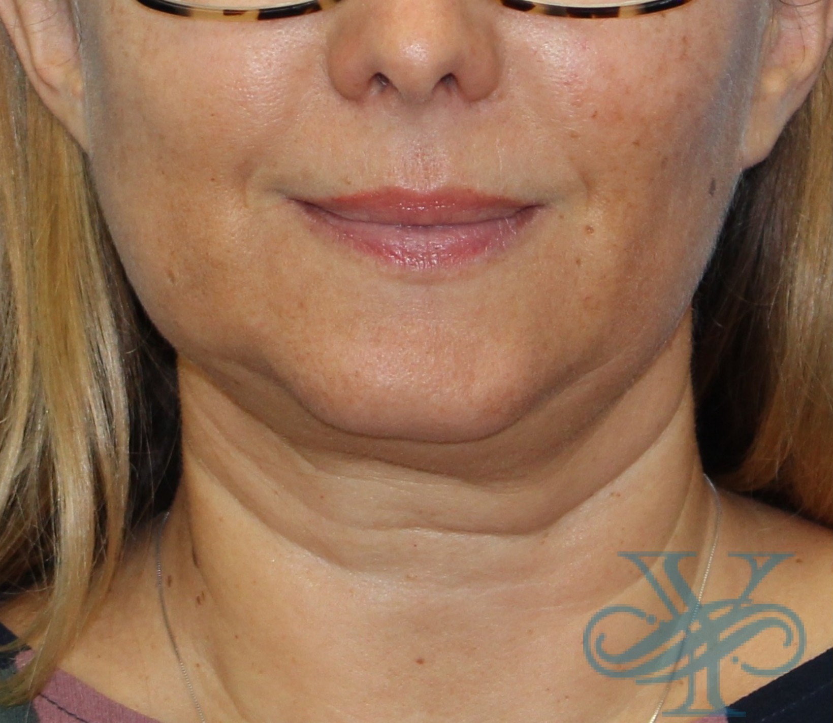 Before Kybella Dr. Yegiyants, Santa Barbara, CA