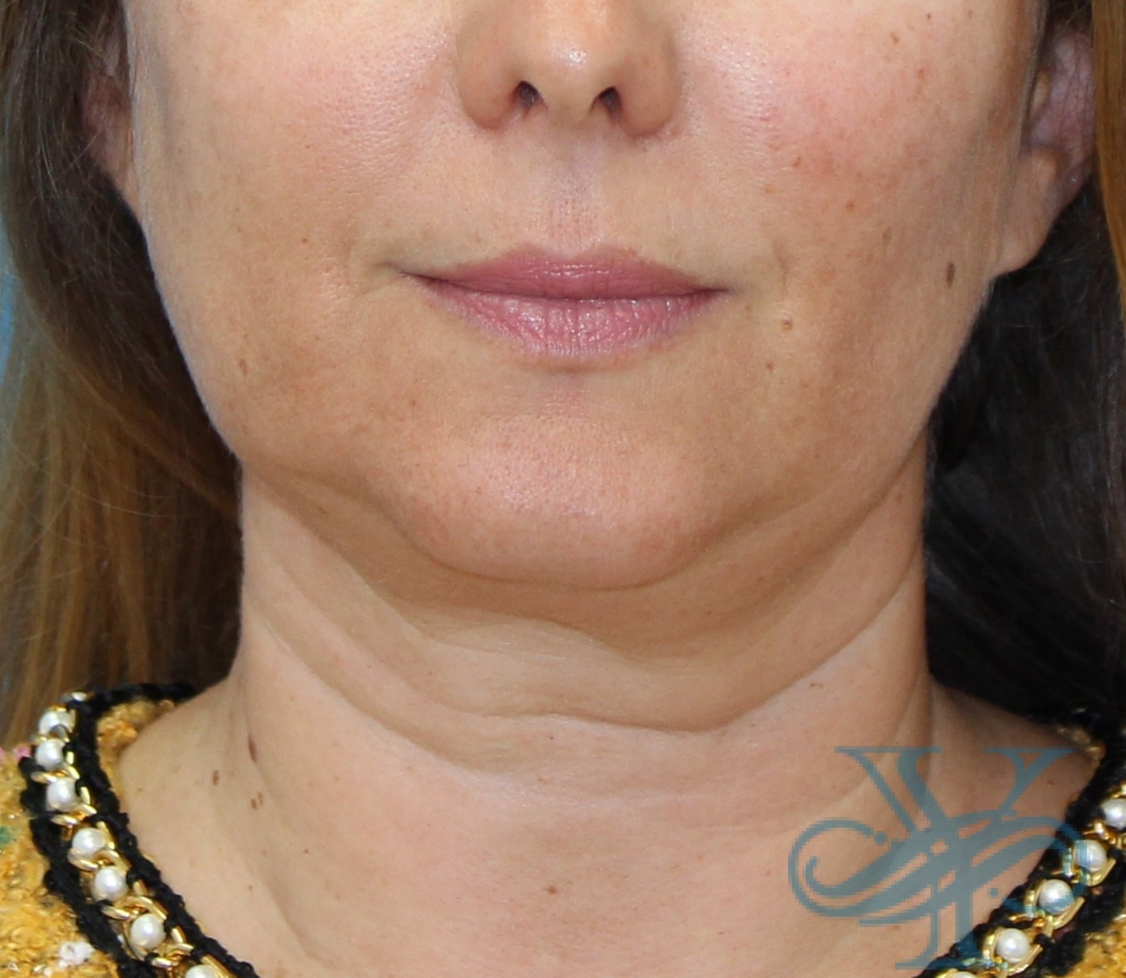 After Kybella Dr. Yegiyants, Santa Barbara, CA