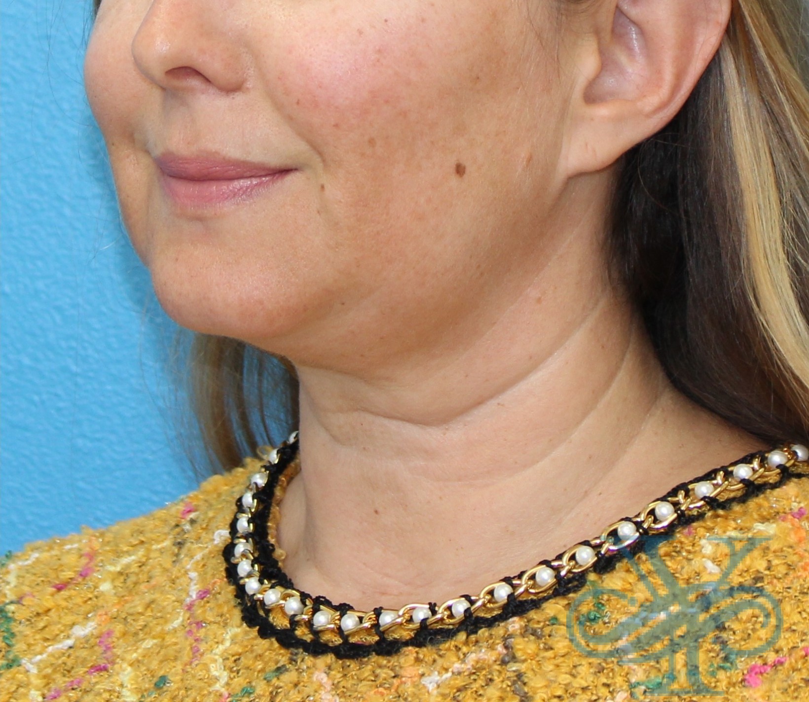 After Kybella Dr. Yegiyants, Santa Barbara, CA