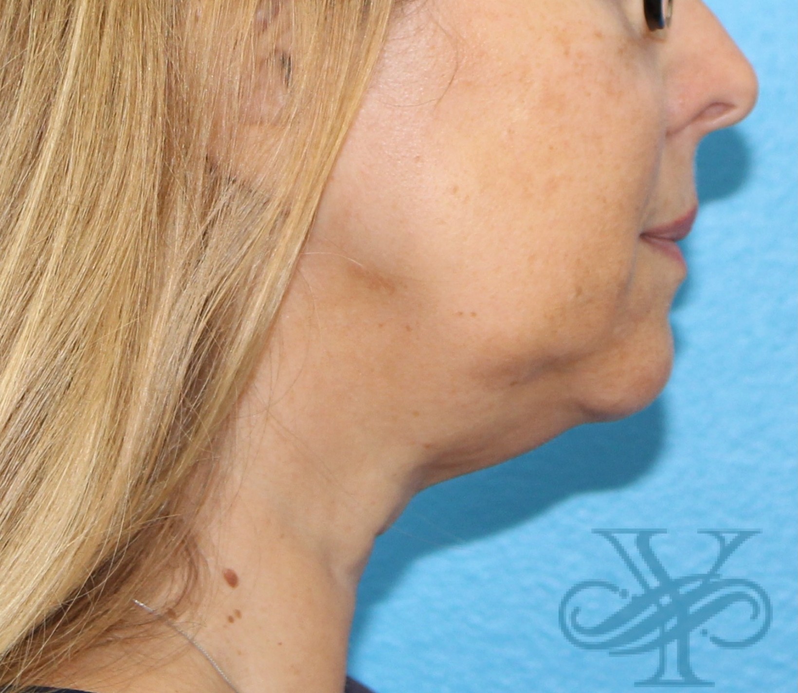 Before Kybella Dr. Yegiyants, Santa Barbara, CA