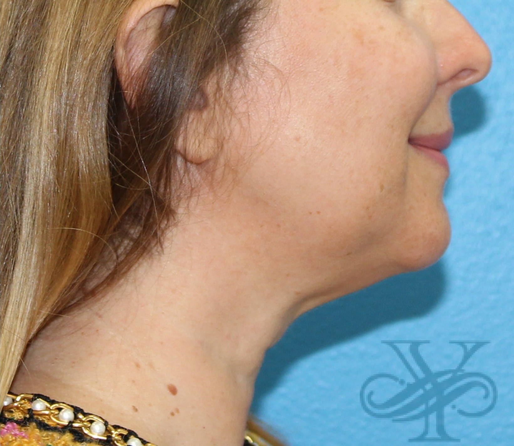 After Kybella Dr. Yegiyants, Santa Barbara, CA