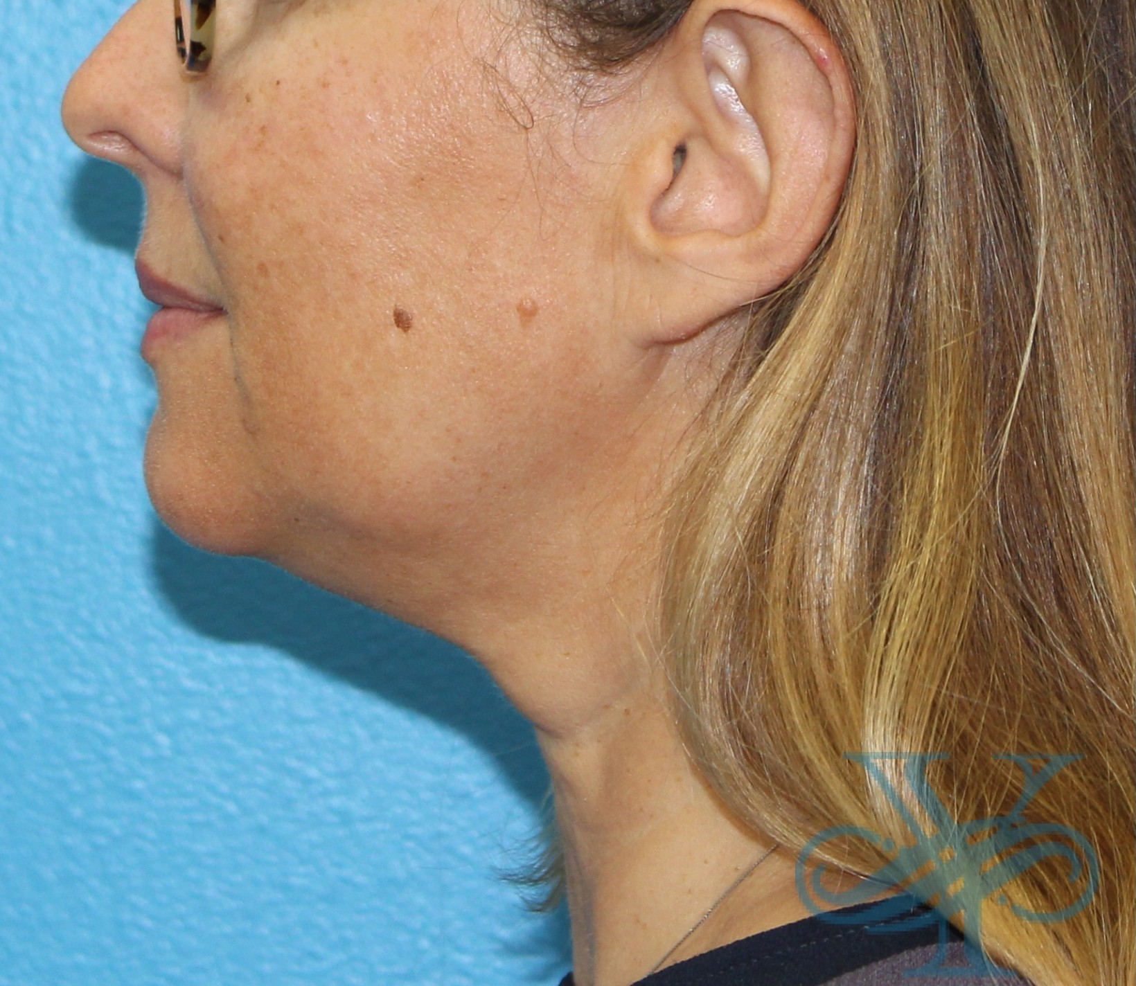 Before Kybella Dr. Yegiyants, Santa Barbara, CA