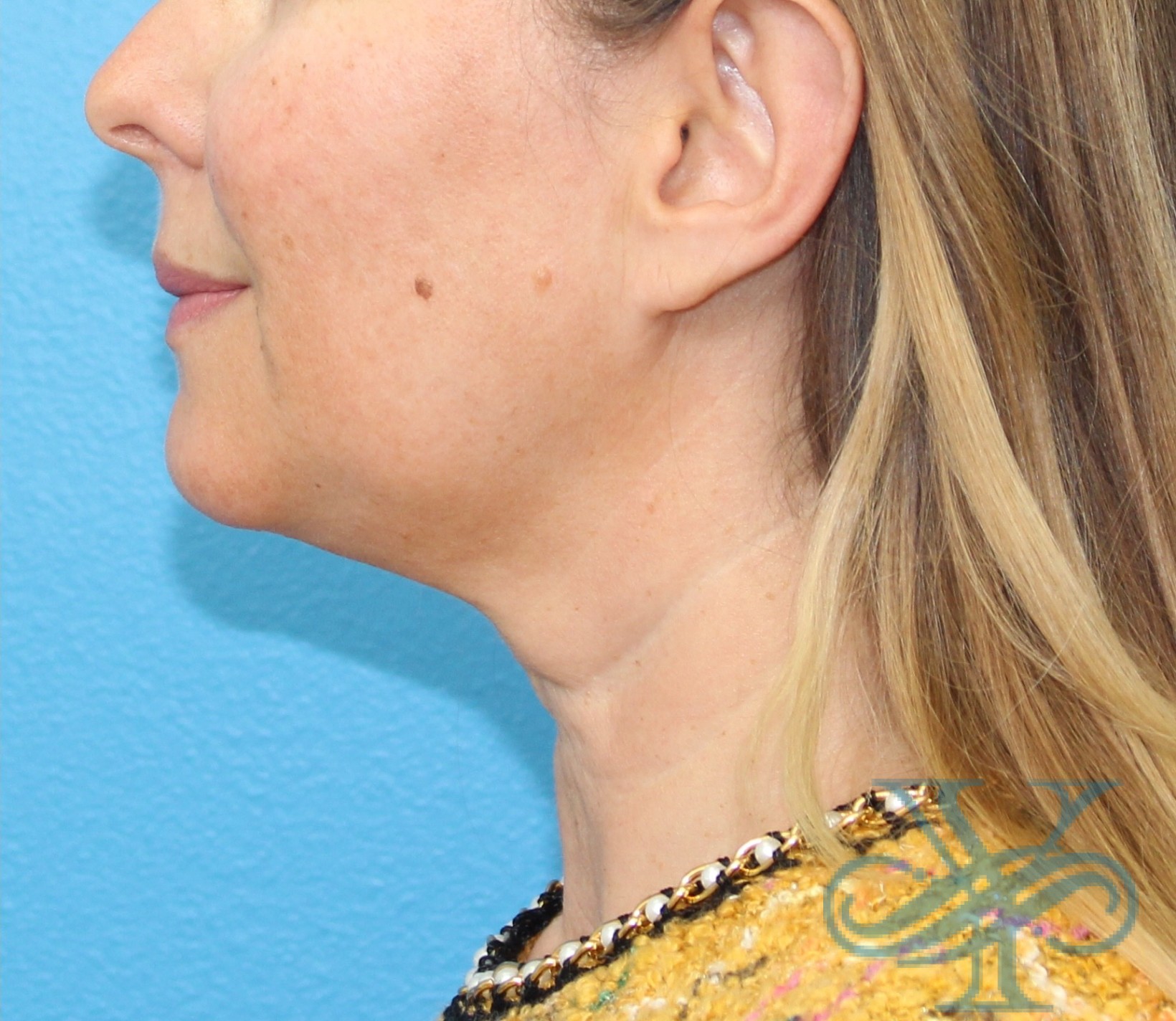 After Kybella Dr. Yegiyants, Santa Barbara, CA