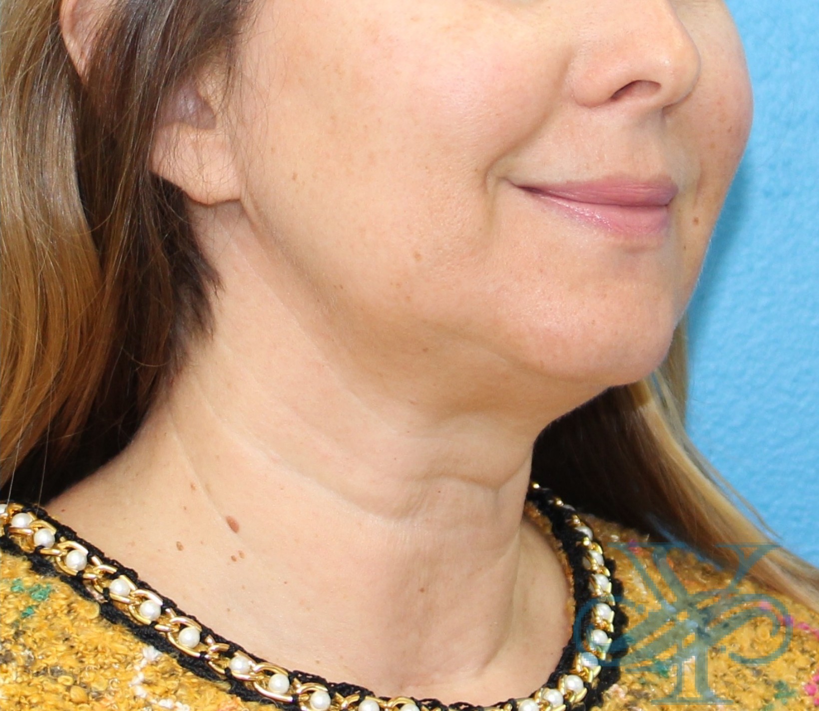 After Kybella Dr. Yegiyants, Santa Barbara, CA