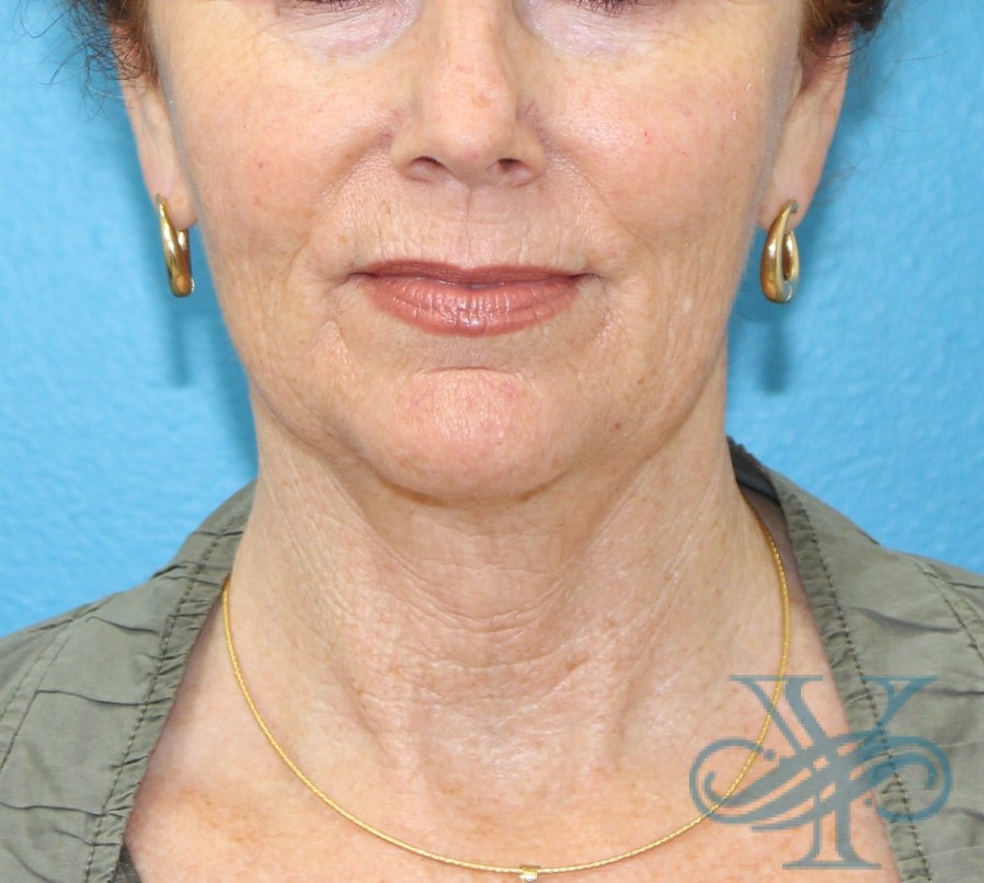 Before facelift and necklift Dr. Yegiyants, Santa Barbara, CA