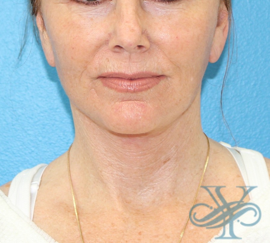 After facelift necklift Dr. Yegiyants, Santa Barbara, Ca