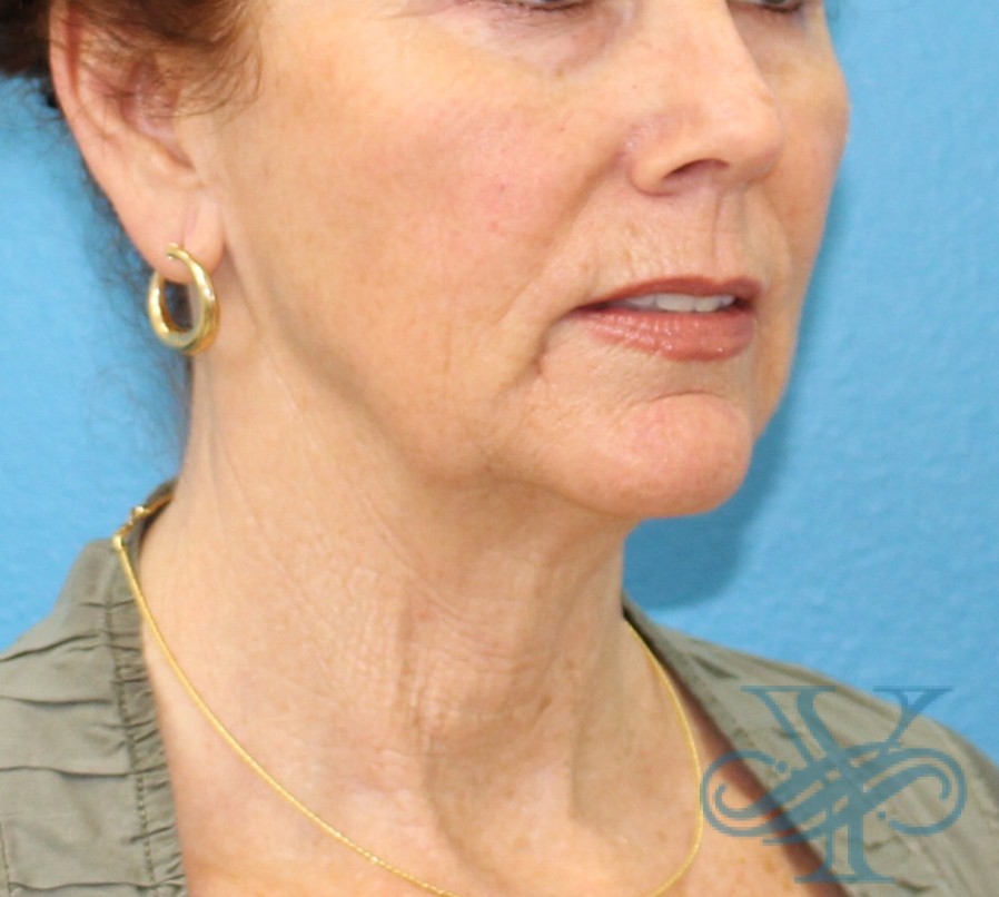 Before facelift and necklift Dr. Yegiyants, Santa Barbara, CA