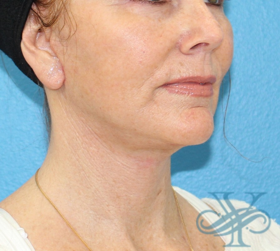 After facelift necklift Dr. Yegiyants, Santa Barbara, Ca