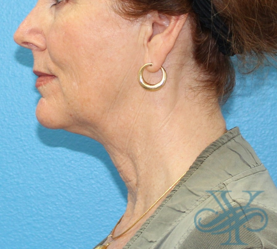 Before facelift and necklift Dr. Yegiyants, Santa Barbara, CA