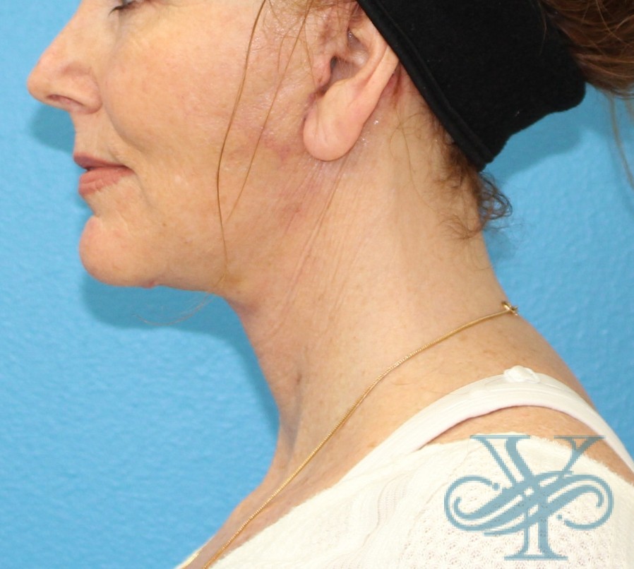 After facelift necklift Dr. Yegiyants, Santa Barbara, Ca