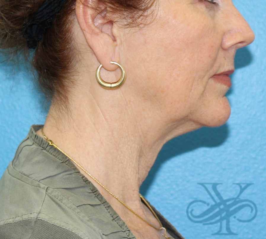 Before facelift and necklift Dr. Yegiyants, Santa Barbara, CA