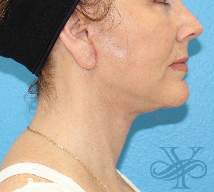 After facelift necklift Dr. Yegiyants, Santa Barbara, Ca