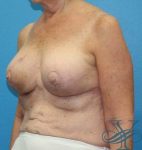 After breast implant replacement Dr. Yegiyants, Santa Barbara, CA