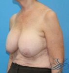 Before breast implant replacement Dr. Yegiyants, Santa Barbara, CA